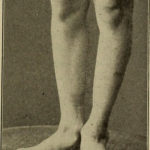 Image from page 666 of “A treatise on orthopedic surgery” (1903)